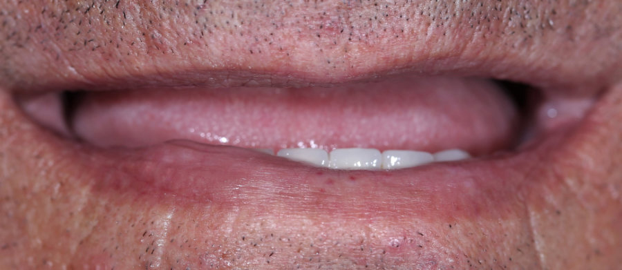 Άμεση Φόρτιση Εμφυτεύματων - Δόντια σε 1 Ημέρα