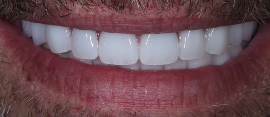 Διαδικασία Τοποθέτησης Οδοντικών Εμφυτευμάτων