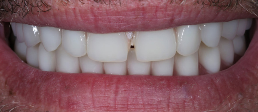 Διαδικασία Τοποθέτησης Οδοντικών Εμφυτευμάτων