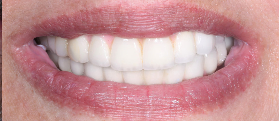 Άμεση Φόρτιση Εμφυτευμάτων - Δόντια σε 1 Ημέρα