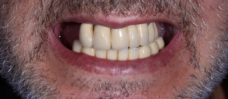 Επένθετη οδοντοστοιχία επι εμφυτευμάτων - πριν