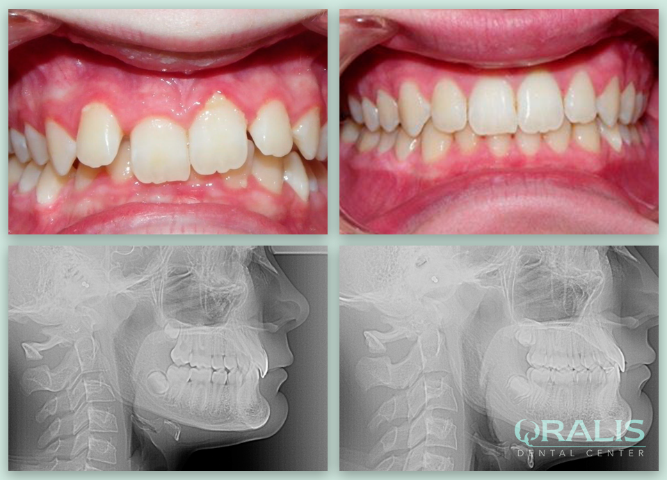 Αόρατα Σιδεράκια Invisalign 1