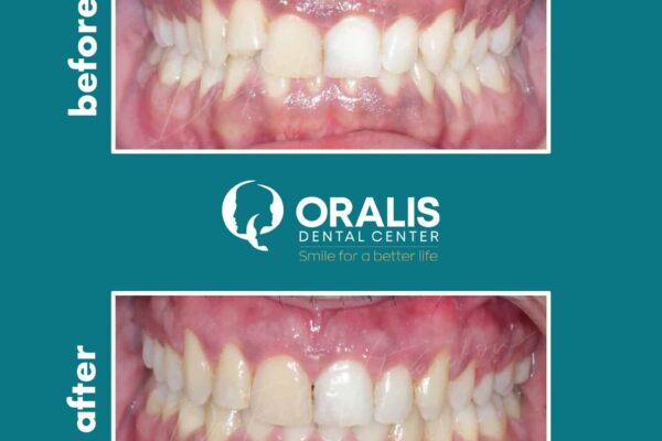 αόρατη ορθοδοντική Invisalign