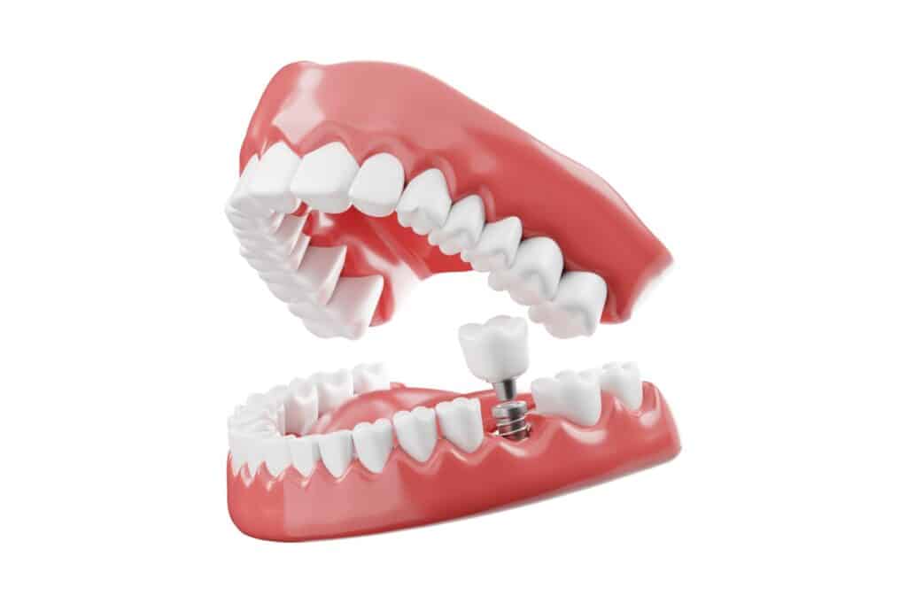 Διαδικασία Τοποθέτησης Οδοντικών Εμφυτευμάτων Εμφυτεύματα δοντιών πόνος