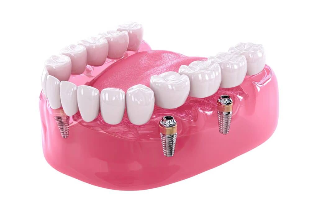 Πονάει η τοποθέτηση εμφυτεύματος; Όλη η αλήθεια για τη διαδικασία και την ανάρρωση Εμφυτεύματα δοντιών πόνος